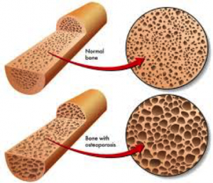 bone muscle loss